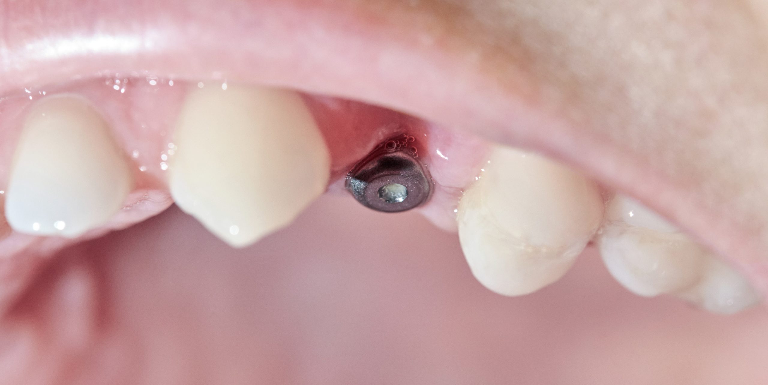 Implantation bei vollständigem Zahnverlust